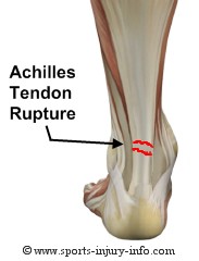 Achilles Tendon