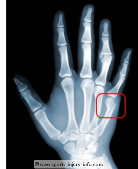 Boxers Fracture - Sports Injury Info