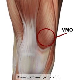 patella femoral syndrome cartoon