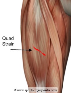 Quadricep Muscle Tear