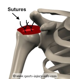 Rotator Cuff Sutures