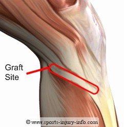 Hamstring Graft Site - Sports Injury Info