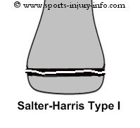 Salter Harris I