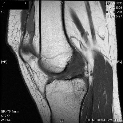My MRI scan - quite interesting! ACL completely torn