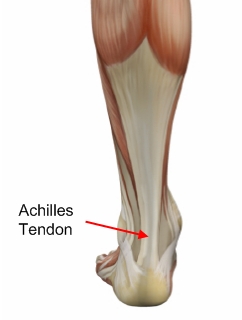 Achilles Tendonitis