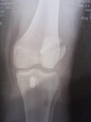 patella fracture after ACL reconsturction