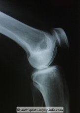 Patella X-ray