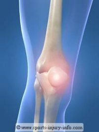 Patellar Tendonitis