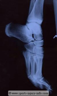 Ankle Sprains - Sports Injury Info
