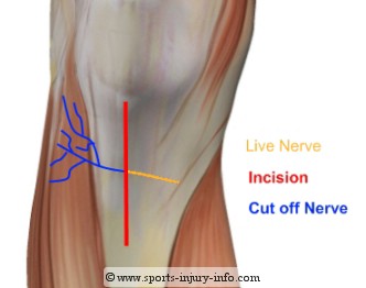 Area of Numbness