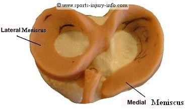 Medial Meniscus Tear