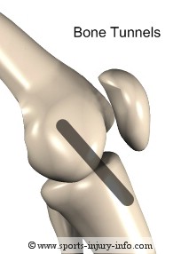 ACL Reconstruction Bone Tunnels