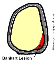 Labral Tear - Bankart Lesion