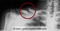 X-ray of Clavicle Fracture