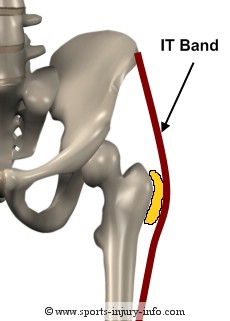 IT Band and Trochanteric Bursa