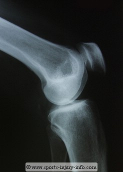 Patella X-ray