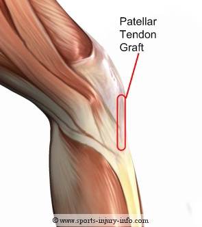 Patellar Tendon Graft Site