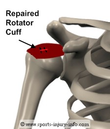 Completed Rotator Cuff Repair