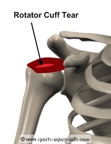 Rotator Cuff Tear