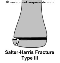 Salter Harris III