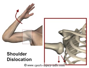 Shoulder Dislocation