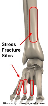 Stress Fracture Sites