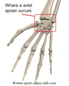 Wrist Sprain - Sports Injury Info