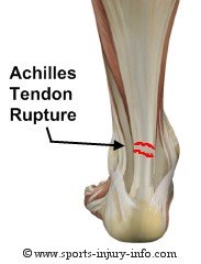 Achilles Tendon Rupture