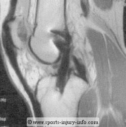 ACL Tear MRI