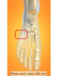 Jones Fracture