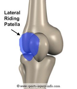 Lateral Riding Patella