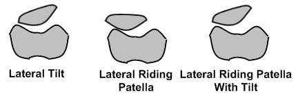 Types of Patellar Mal-alignment