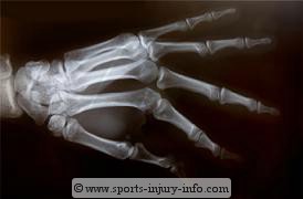 Hand X-Ray Fracture