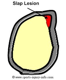 SLAP Lesion