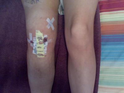 My Pretty Knee 2 Days After Surgery