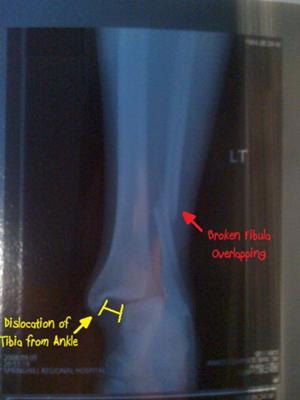 My Leg X-ray