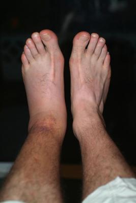 36 Hours After Injury