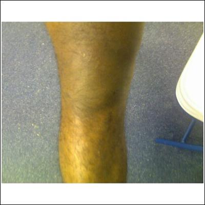 Swelling of right knee